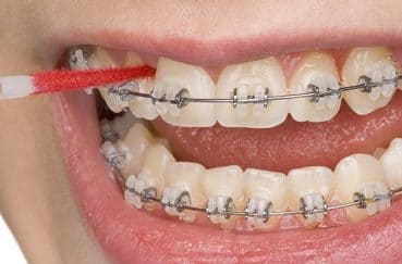 普段より念入りに！「矯正中」の正しい歯磨きのやり方