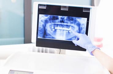 歯科の治療でのレントゲン撮影って必要なの？