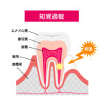 <span class="title">歯がしみる！知覚過敏の原因と対策</span>