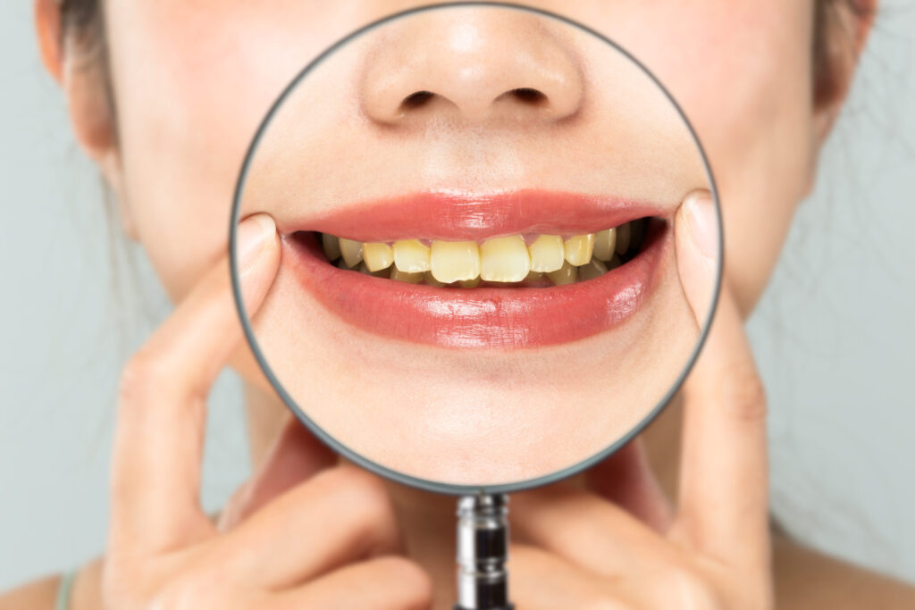 <span class="title">歯の黄ばみの原因って何？</span>